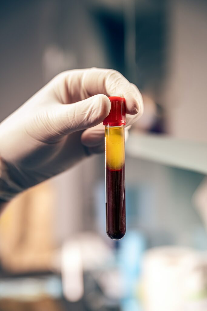 Extraction of plasma from blood